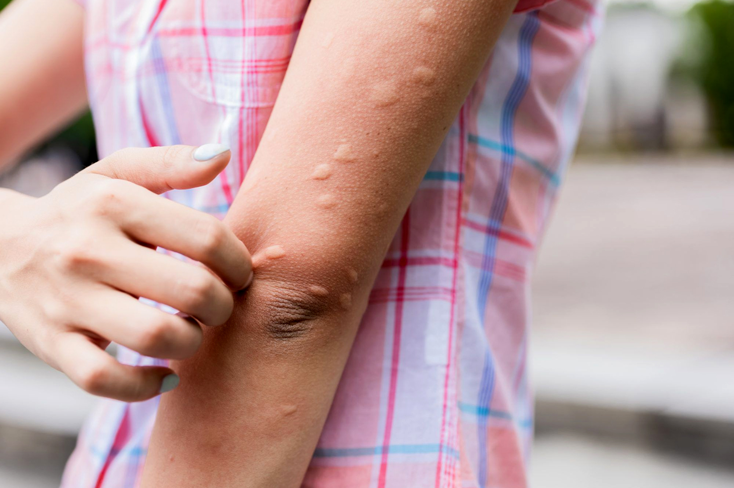 What are the of causes hives? | What are the symptoms of hives? | How long do hives last? | When to seek medical treatment for hives? | How are the hives treated and cured? | Various pictures of hives | diseases that cause hives in adults male and female | what are the Causes of hives in female adults | Can hives be a sign of something serious diseases |Various treatment of hives | How to cure hives fast and quick | Pictures of hives rash on legs and hand
